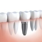 Ile kosztują implanty zębowe?