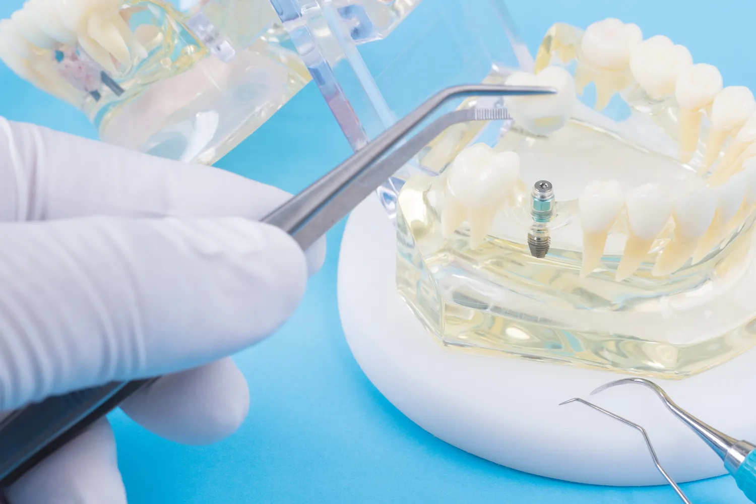 Zęby w jeden dzień Świnoujście