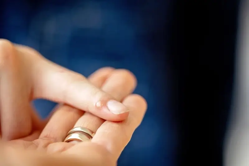 Ile kosztuje usunięcie kurzajki u dermatologa?